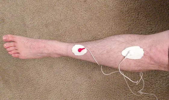 TENS unit for shin splints